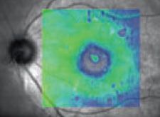 Abbildung - Vitreomamakuläre Traktion mit geografischer Atrophie