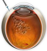 Abbildung - Intravitrealeinjektion