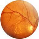 Aufnahme - Schlaganfall Netzhaut