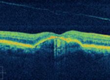 Abbildung - Altersbedingte Makuladegeneration