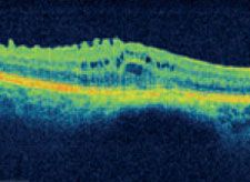 Aufnahme - Epiretinale Membran
