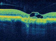 Abbildung - Vitreomamakuläre Traktion mit geografischer Atrophie
